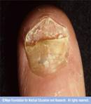 Photo of an infected nail
