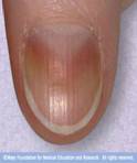 Photo of vertical nail ridges 
