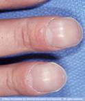 Photo showing clubbing of fingers
